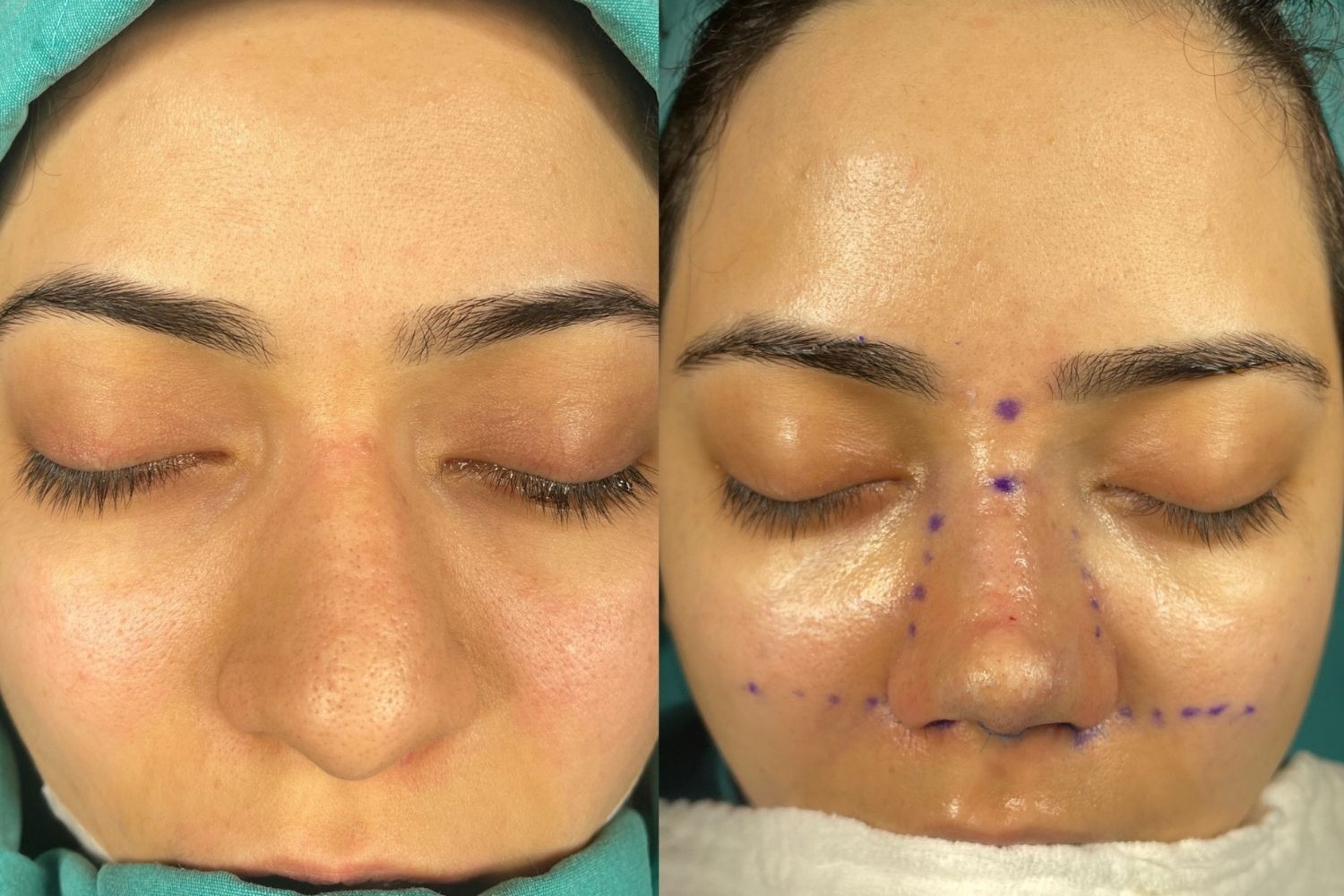 Facial Plastic Surgery