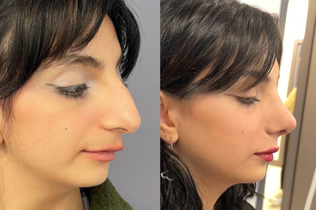 Revision Rhinoplasty 6