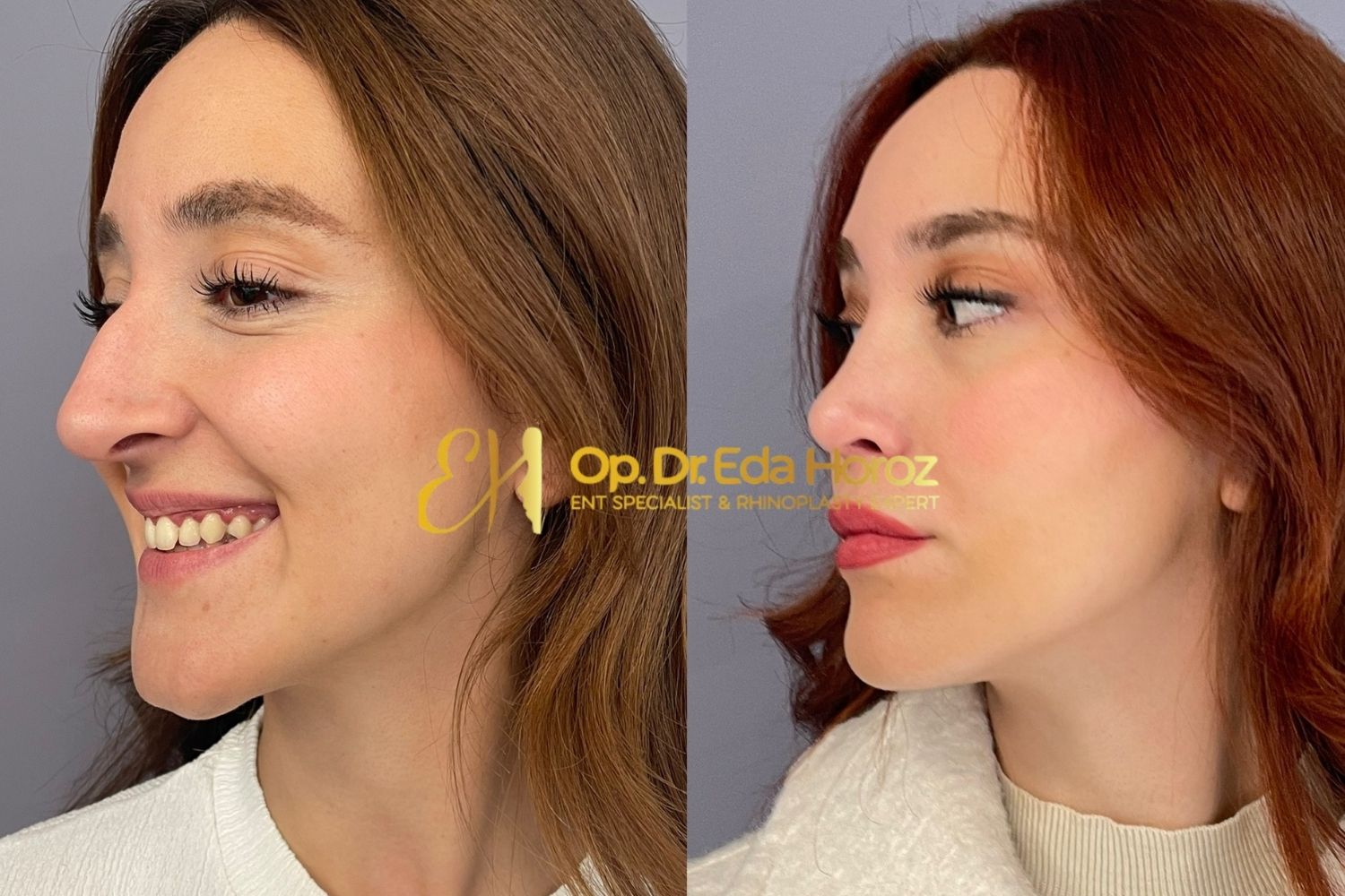 Revision Rhinoplasty 7 (2)