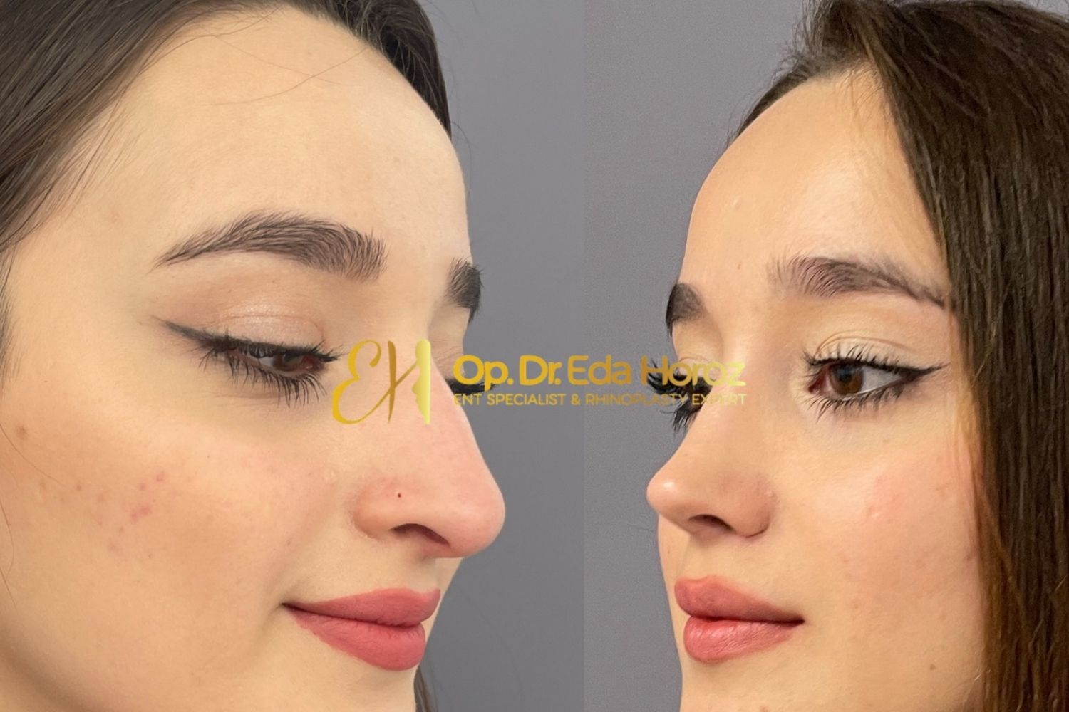 Revision Rhinoplasty 7 (3)
